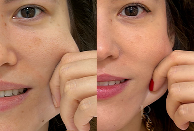 Comparativo antes e depois de paciente da Rhévora, imagem 1