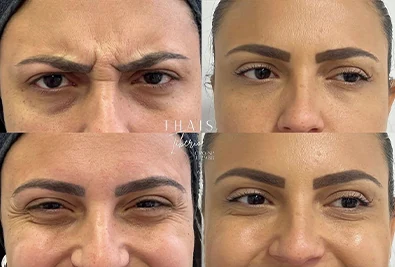 Comparativo antes e depois de paciente da Rhévora, imagem 4