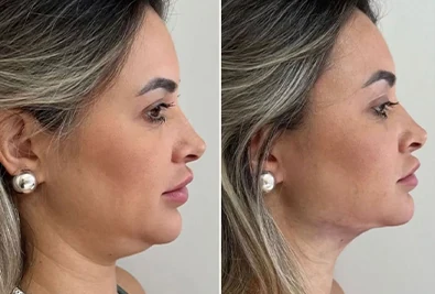 Comparativo antes e depois de paciente da Rhévora, imagem 6