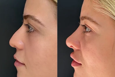 Comparativo antes e depois de paciente da Rhévora, imagem 7