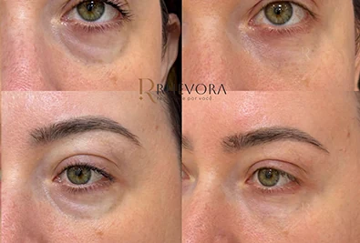 Comparativo antes e depois de paciente da Rhévora, imagem 11
