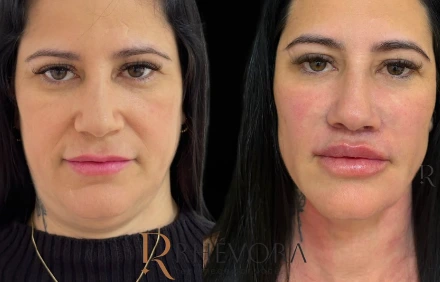 Resultado antes e depois de paciente da Rhévora