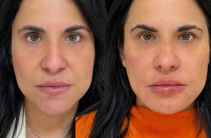Resultado antes e depois de paciente da Rhévora