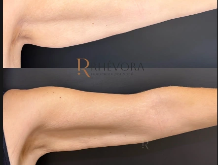 Antes e depois de tratamento no braço de paciente da Rhévora