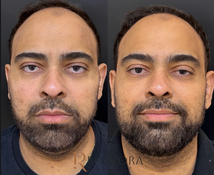 Antes e depois de paciente da Rhévora